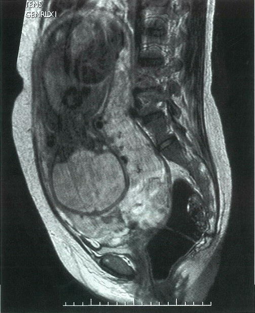 癒着胎盤 医師国家試験対策wiki Atwiki アットウィキ