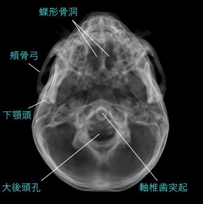 頭部軸位撮影 - 一般撮影室 - atwiki（アットウィキ）