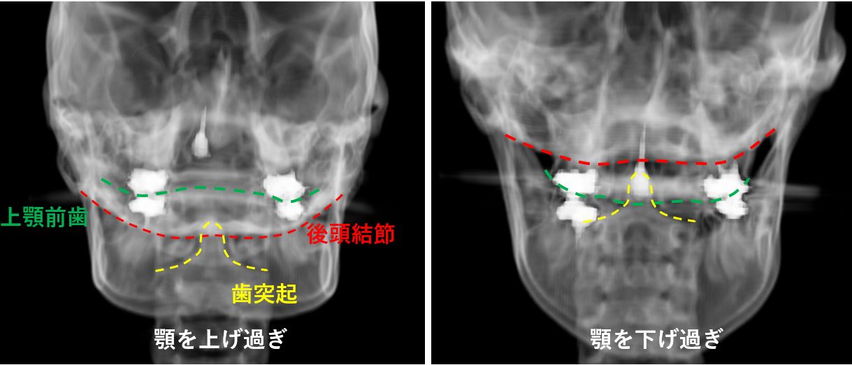 頸椎開口位撮影 一般撮影室 Atwiki アットウィキ